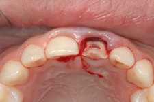 外傷歯４