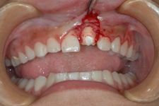 外傷歯６
