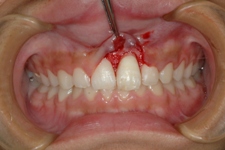 外傷歯7