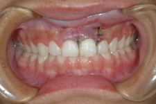 外傷歯8