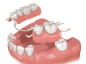保険義歯