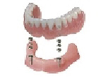 磁性体義歯