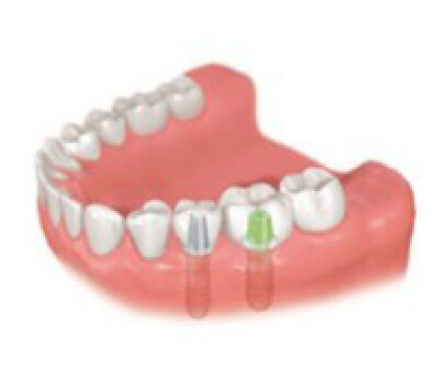 あい歯科クリニックのインプラント治療