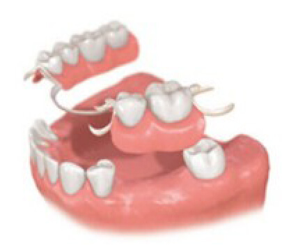 あい歯科クリニックのインプラント治療